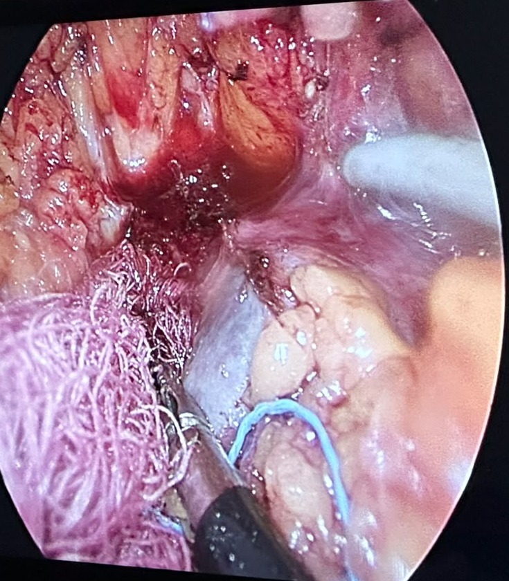Close-up endoscopic view of adrenal vessel dissection during retroperitoneal adrenalectomy