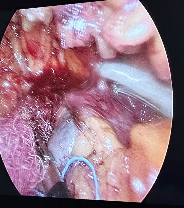 Endoscopic view of the retroperitoneal working space during adrenalectomy
